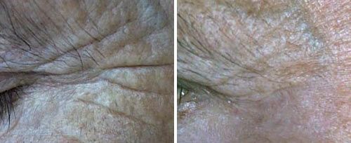 periocular_resurfacing_dr_paciolla